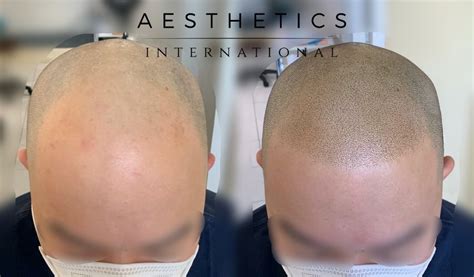 microblading in the philippines|Scalp Micropigmentation Manila, Philippines.